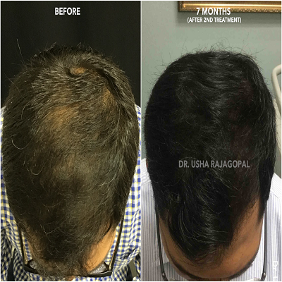 Acell PRP Treatment for Hair Loss საქართველო