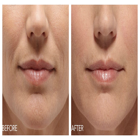 Belotero Fillers საქართველო