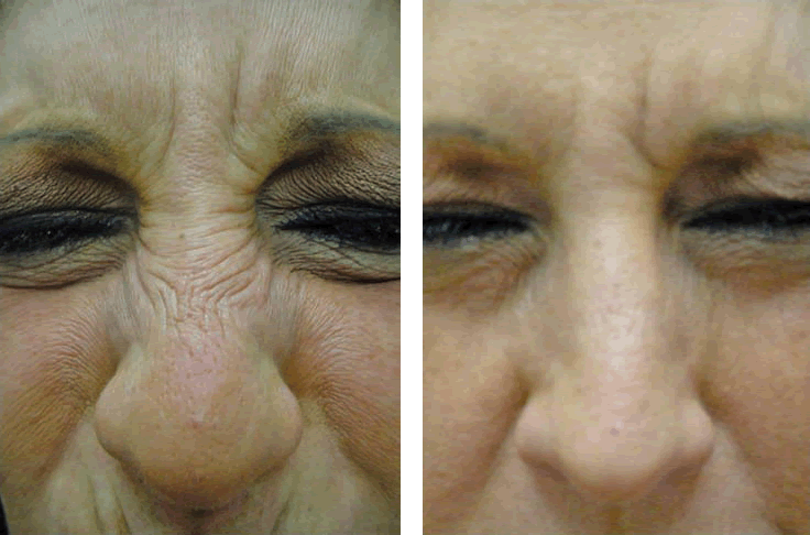 Botox For Nose საქართველო