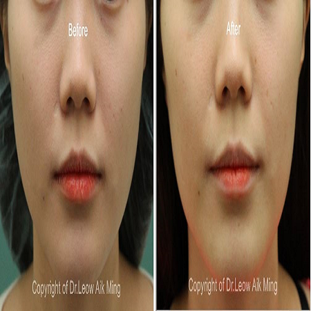 Botulinum Toxin საქართველო