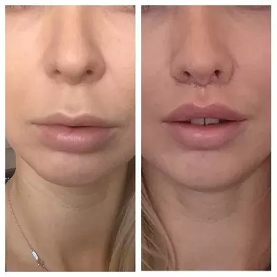 Bullhorn Lip Lift საქართველო