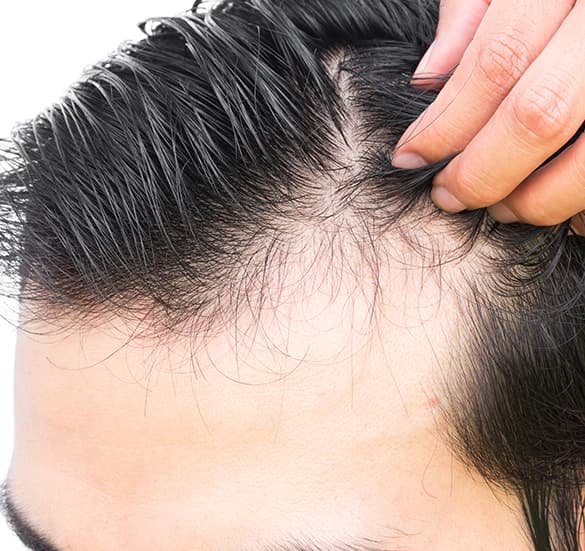 DHI Direct Hair Implant საქართველო