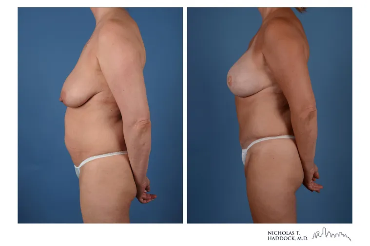 DIEP Flap Breast Reconstruction საქართველო