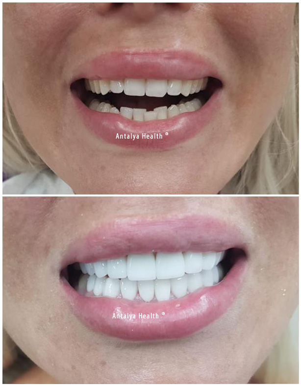 E-Max Veneers საქართველო