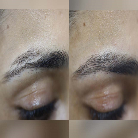 Eyebrow Hair Transplant საქართველო