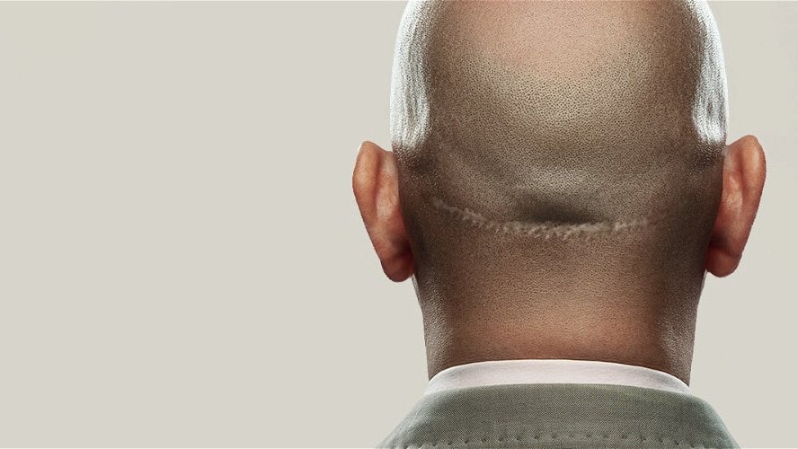 FUT Strip Hair Transplant საქართველო