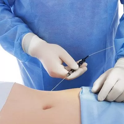 GPS Laser Liposuction საქართველო