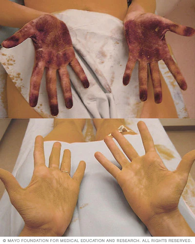 Hyperhidrosis Treatment საქართველო