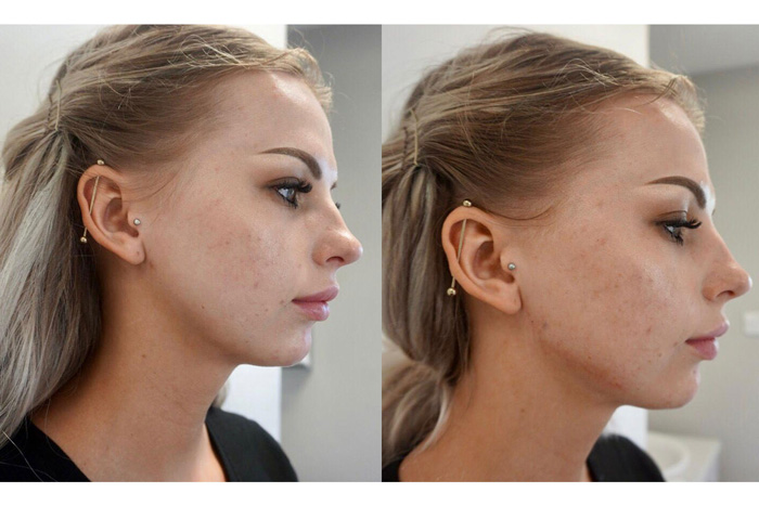 Jawline Contouring საქართველო