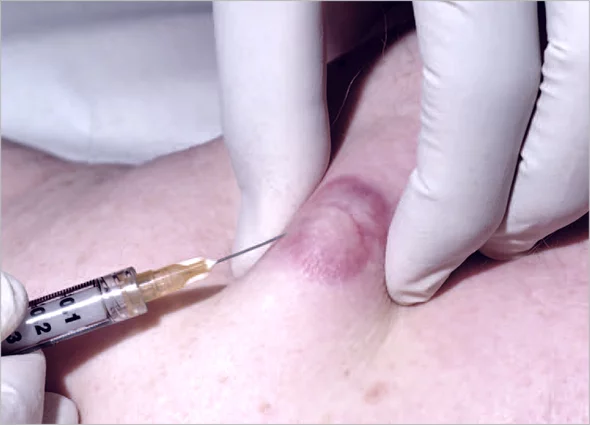 Keloid Treatment საქართველო