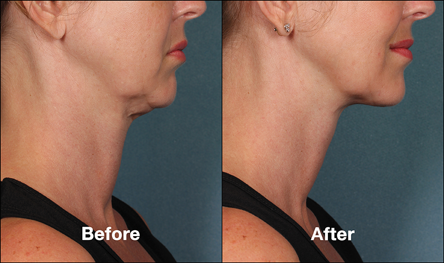 Kybella Treatment საქართველო
