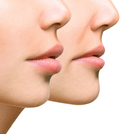lip reduction surgery საქართველო