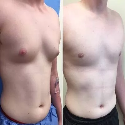 Lipo Chest Surgery საქართველო