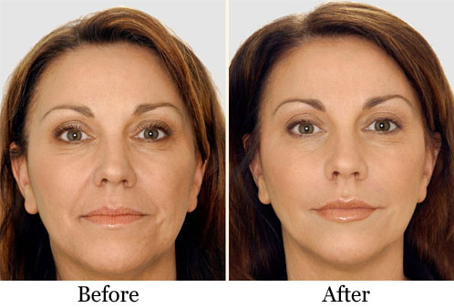 Liquid Facelift საქართველო