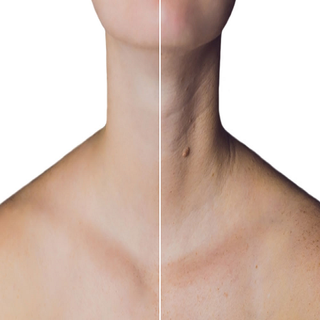 Botox For Neck საქართველო