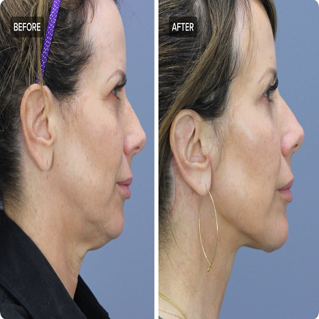 Neck Lift Surgery საქართველო