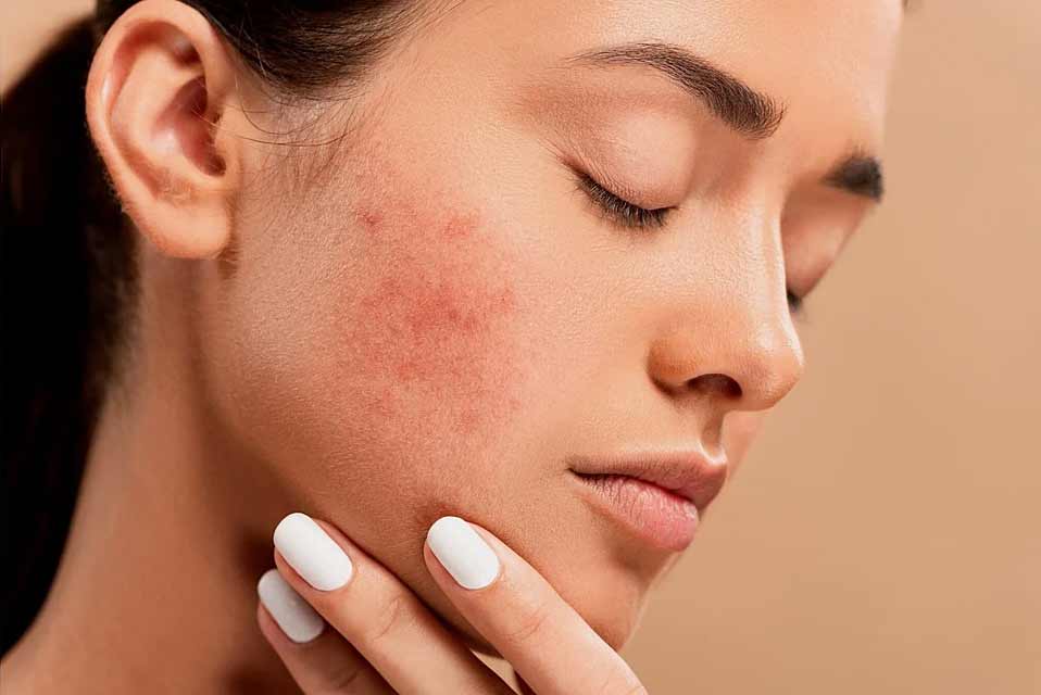 Pimples Treatment საქართველო