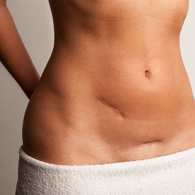 Post Surgical Scars Treatment საქართველო