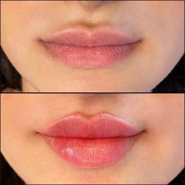 Russian Lip Fillers საქართველო