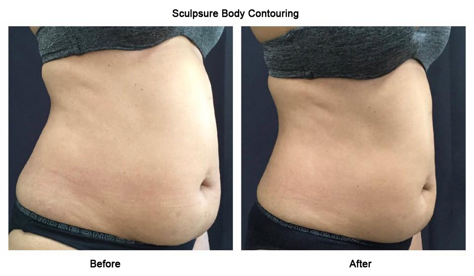 Sculpsure Body Controuring საქართველო