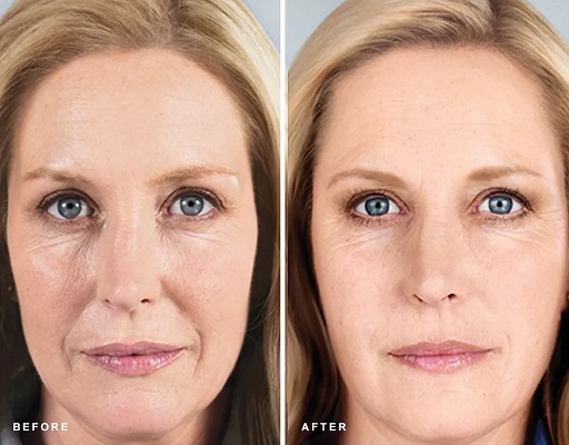 Sculptra fillers საქართველო