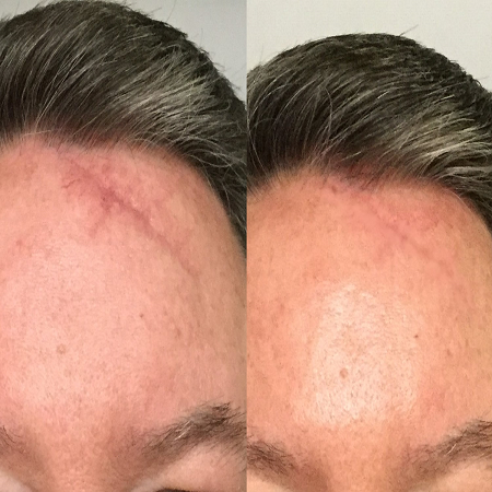 Surgical Scar Revision საქართველო