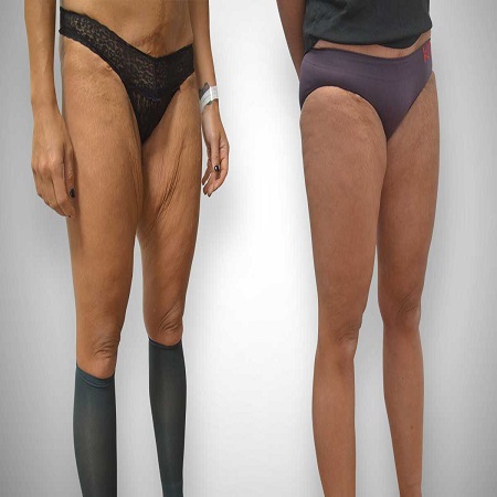 Thigh Lift საქართველო