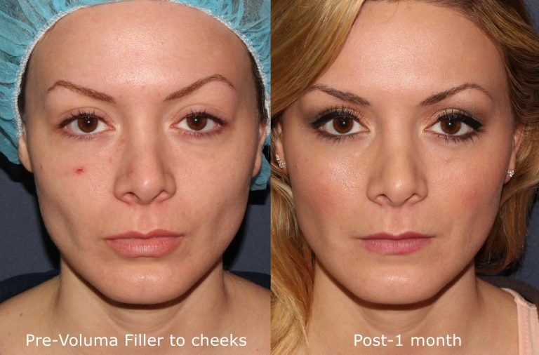 Voluma Fillers საქართველო