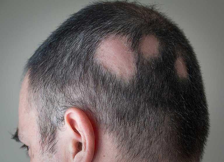 Alopecia Areata Treatment საქართველო