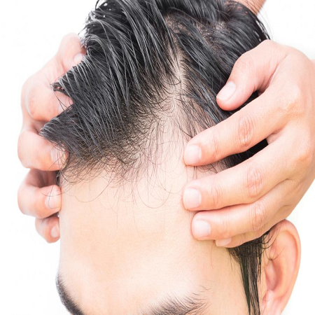 Baldness Treatment for Male საქართველო