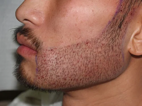 Beard Hair Transplant საქართველო