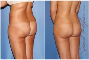 Body Jet Liposuction საქართველო