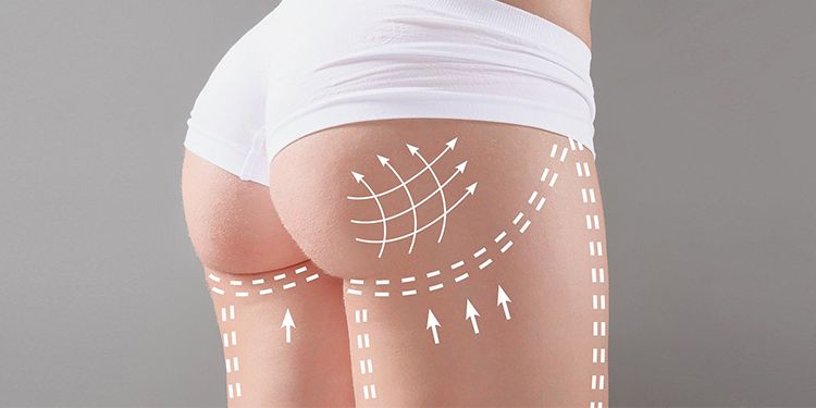 Buttock Lift საქართველო