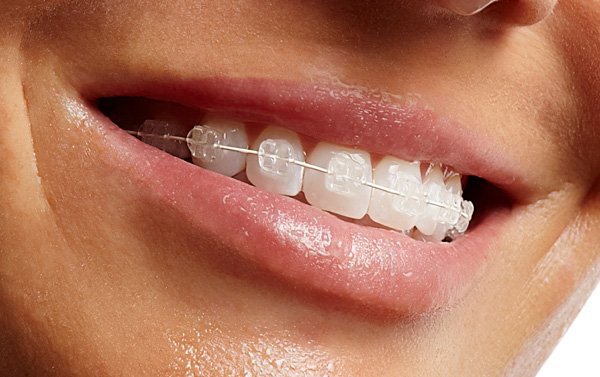 Ceramic Braces საქართველო