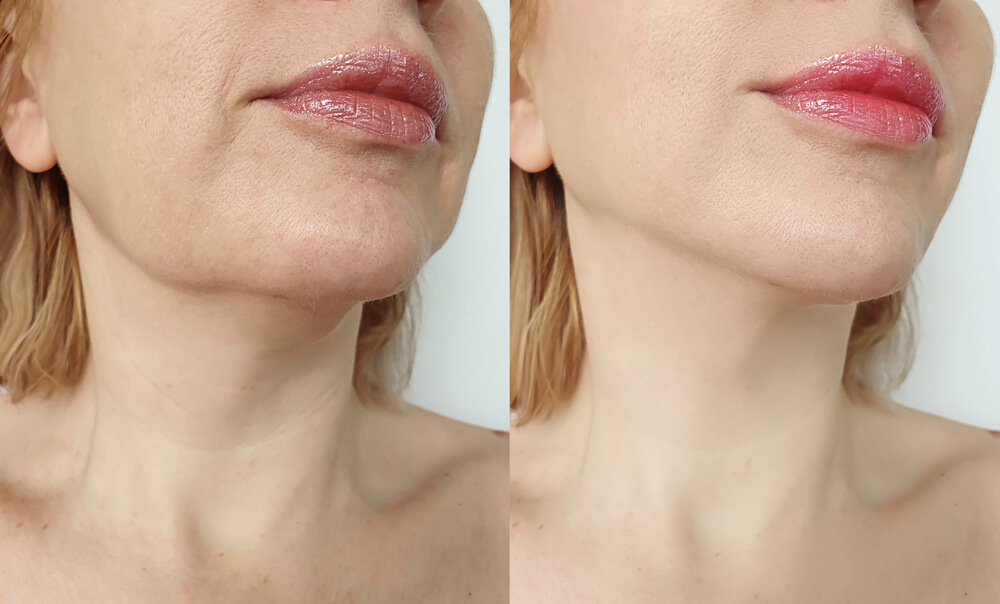 Chin Reduction საქართველო