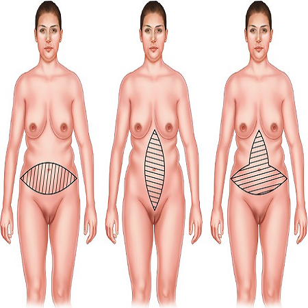 circumferential abdominplasty საქართველო