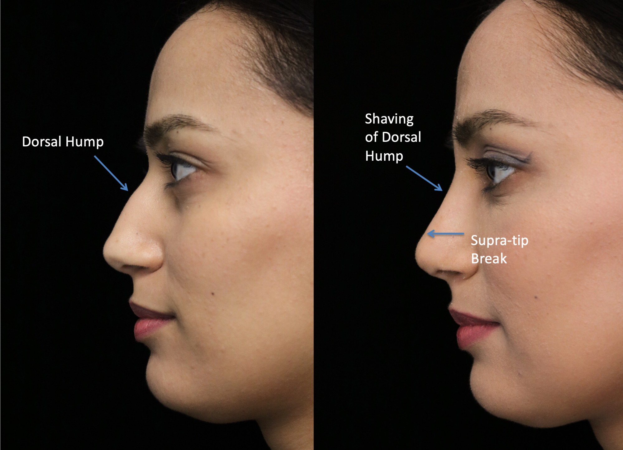 Closed Rhinoplasty საქართველო