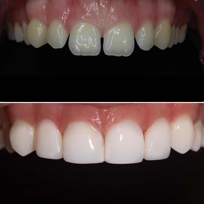 Composite Veneers საქართველო