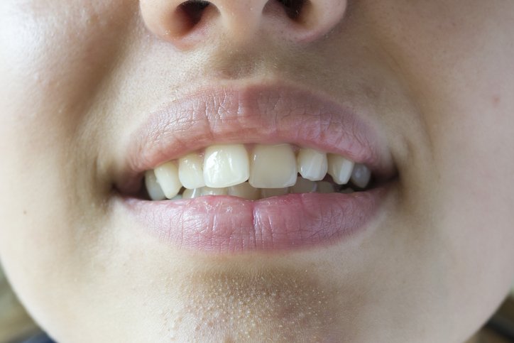Crooked Teeth Treatment საქართველო