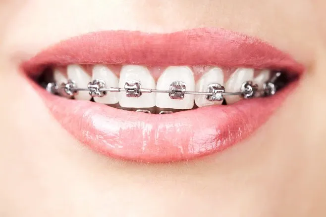 Damon Braces System საქართველო