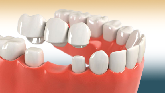 Dental Crown and Bridges საქართველო