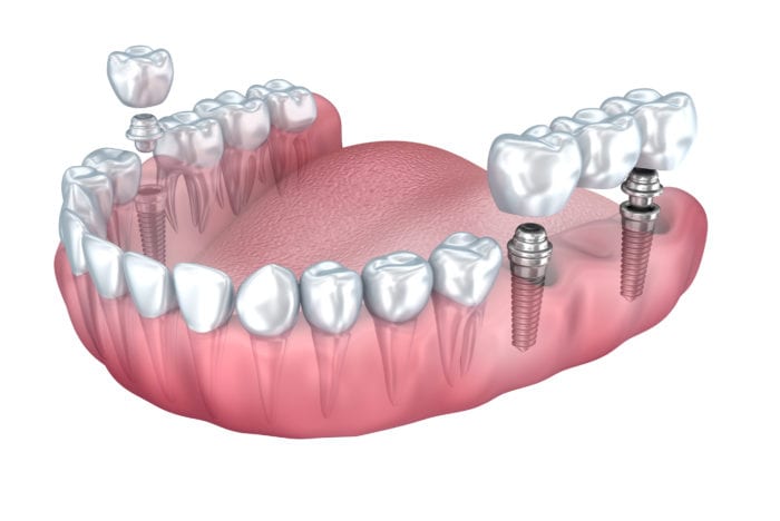 Dental Implants საქართველო
