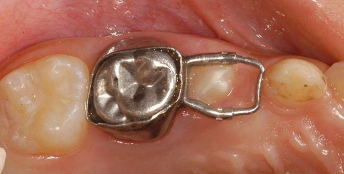 Dental Space Maintenance საქართველო