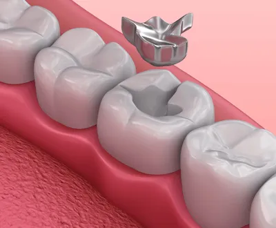 Dental Tooth Filling Treatment საქართველო