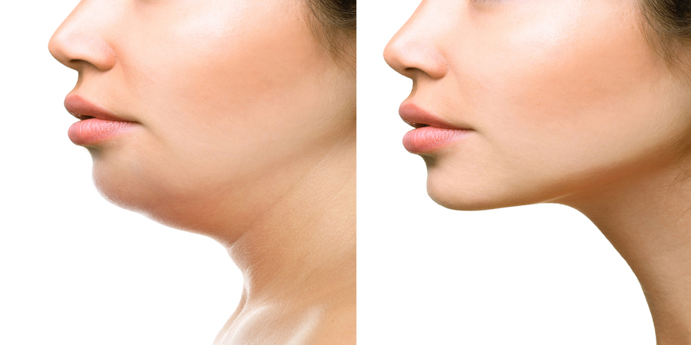 Double Chin Liposuction საქართველო