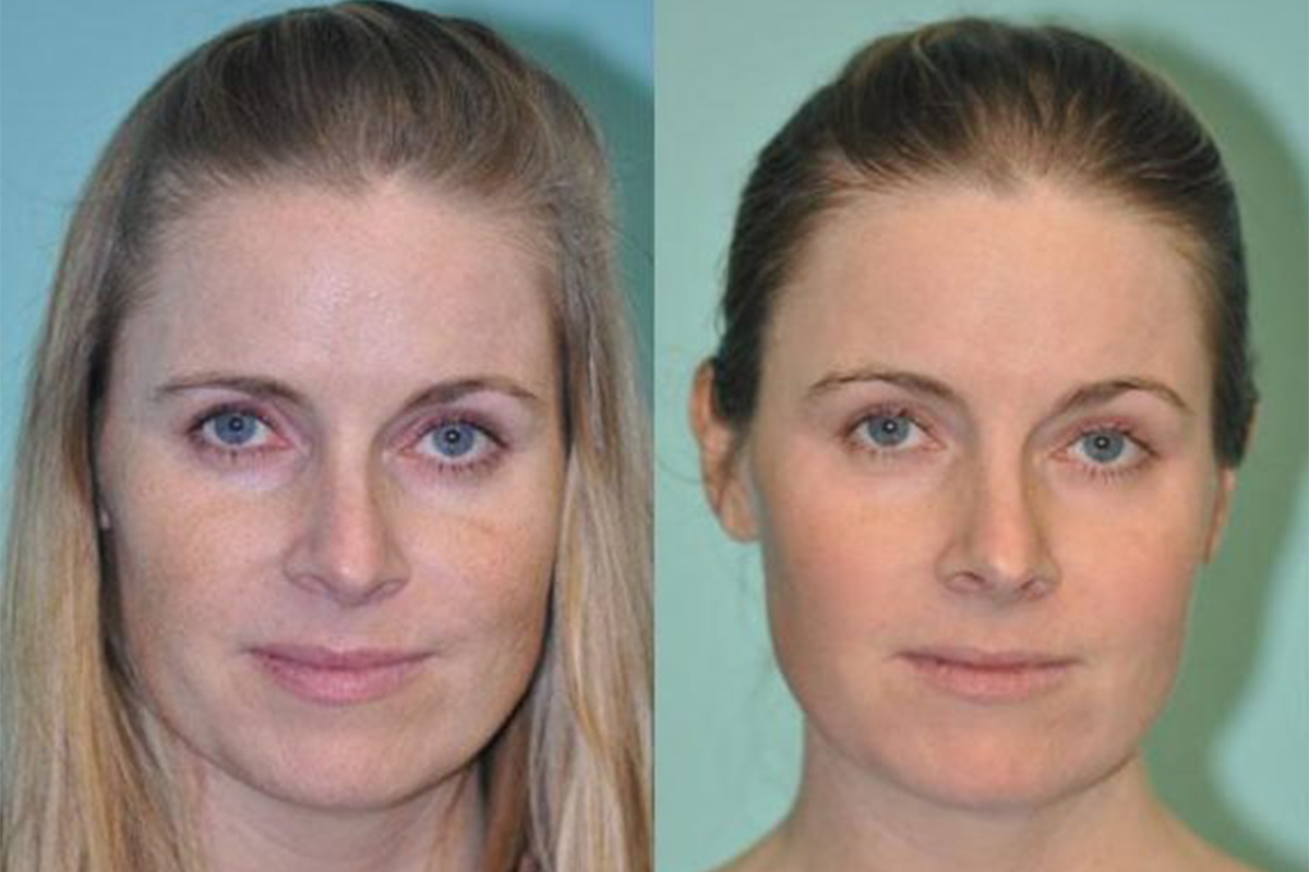 Erbium Peeling საქართველო