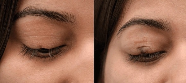 Eyelash Hair Transplant საქართველო 