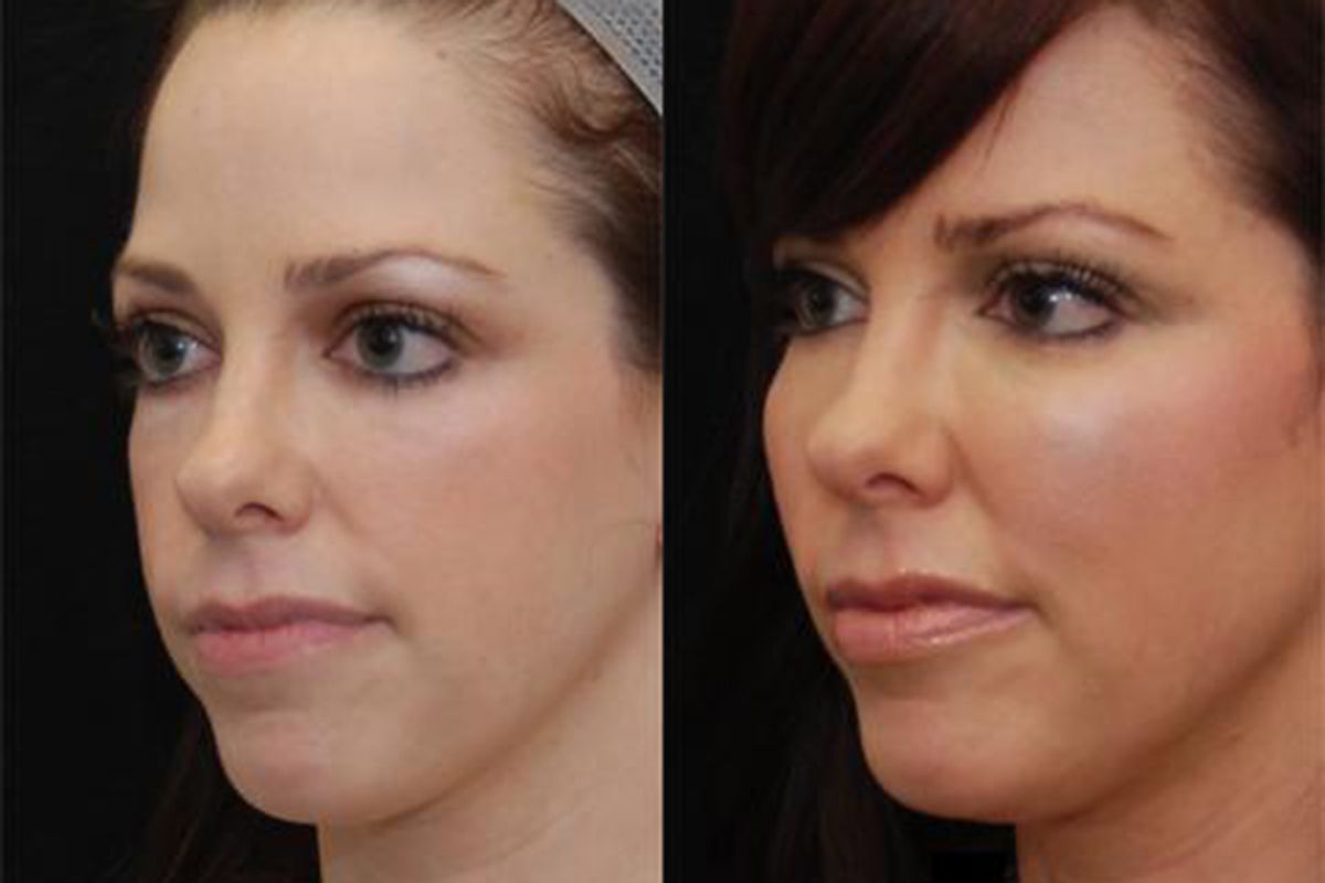 Fat Injections Fat Transfer საქართველო