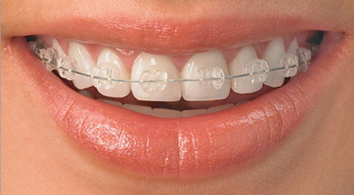 Fixed Appliances Treatment საქართველო