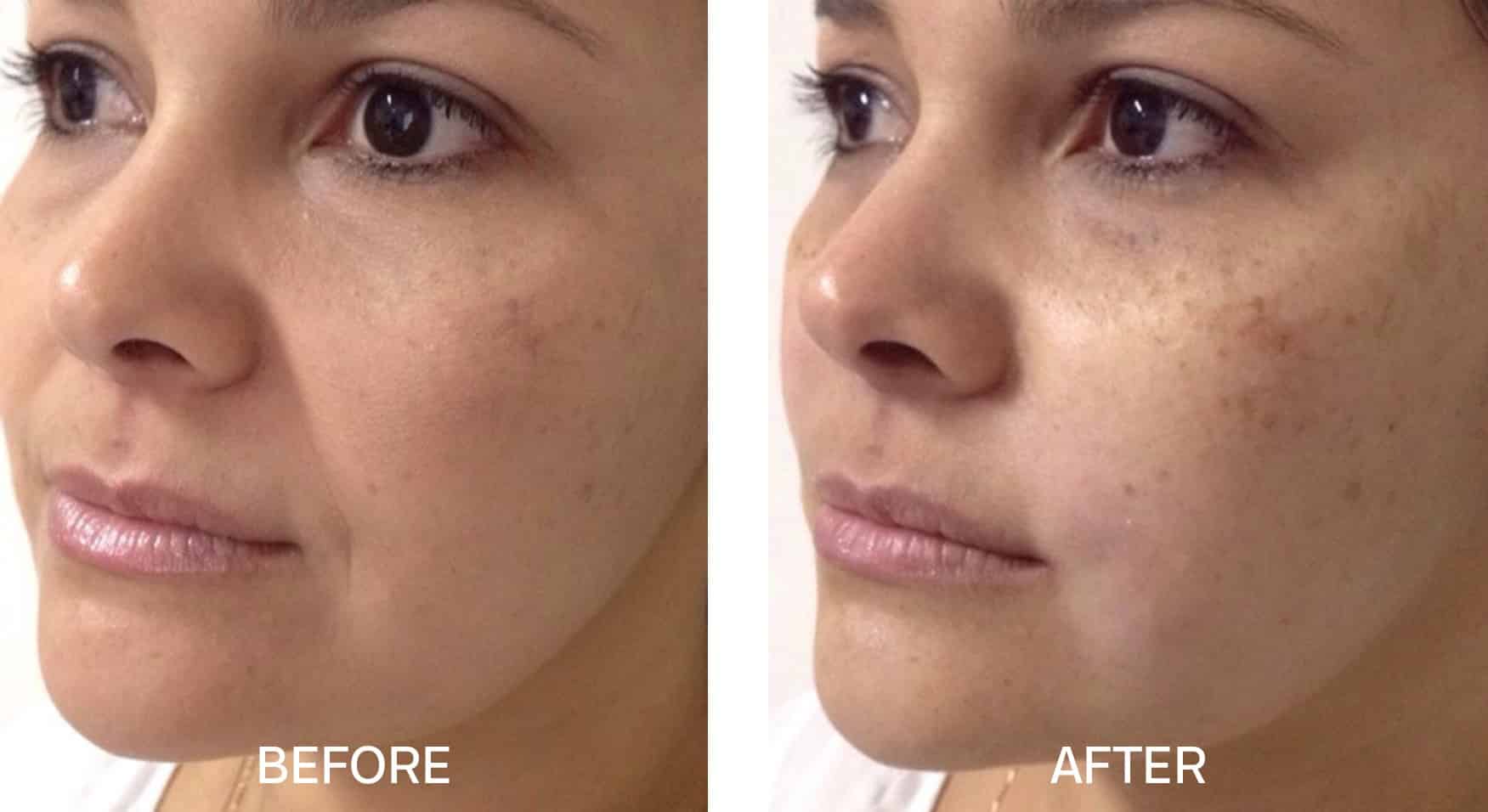 Fotona 4D for Face საქართველო